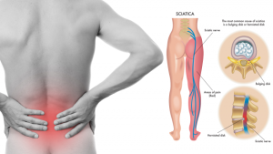 Read more about the article 8 Sciatica Stretches That Prevent and Relieve Hip and Lower Back Pain