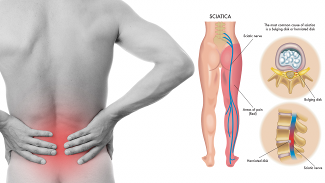 You are currently viewing 8 Sciatica Stretches That Prevent and Relieve Hip and Lower Back Pain